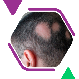 Alopecia Areata