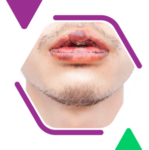 Lip reduction