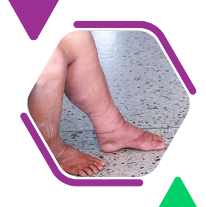 Lymphedema