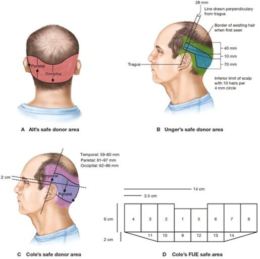 hair transplant