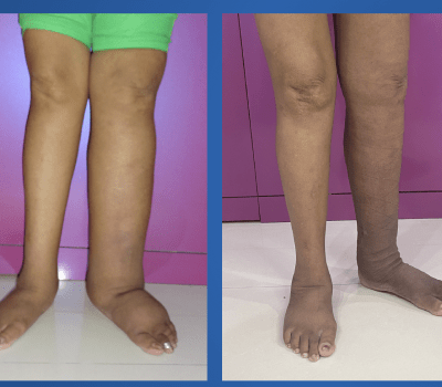 lymphedema