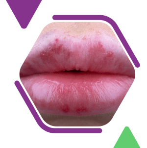 lip augmentation