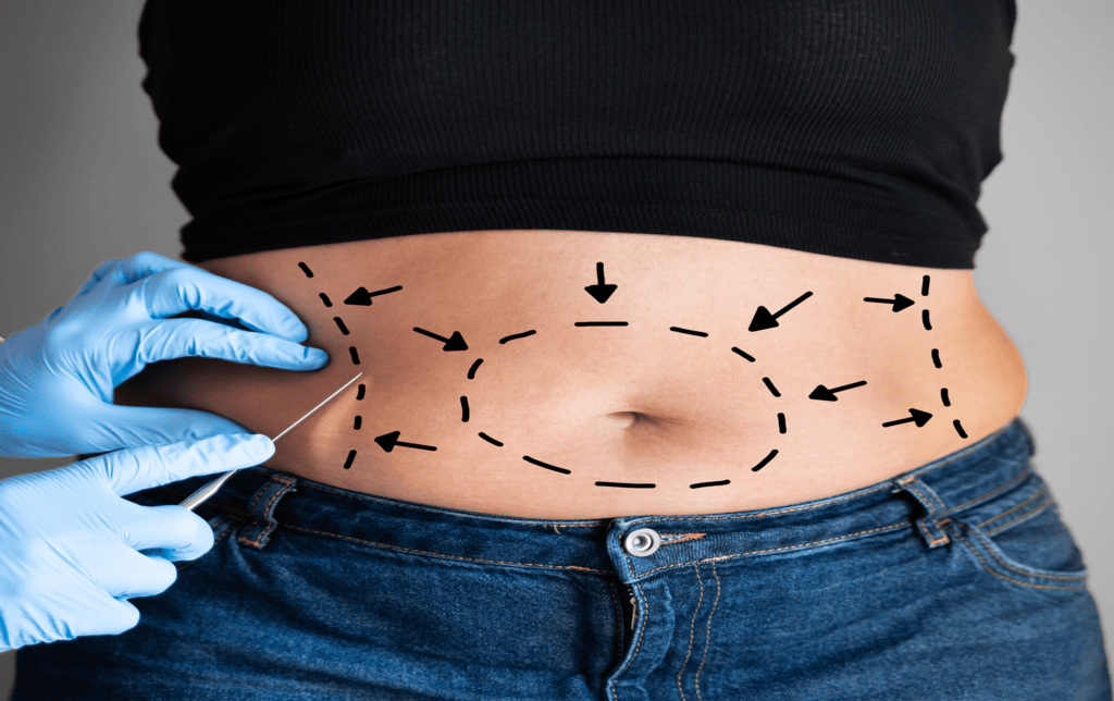 abdominoplasty