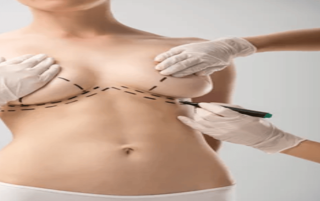 Breast Mastopexy Surgery Achieving a Youthful and Uplifted Appearance 1 Plastic Surgeon in Nagpur | Cosmetic Surgeon in Nagpur | Dr. Suresh Chawre | Hair Transplant In Nagpur