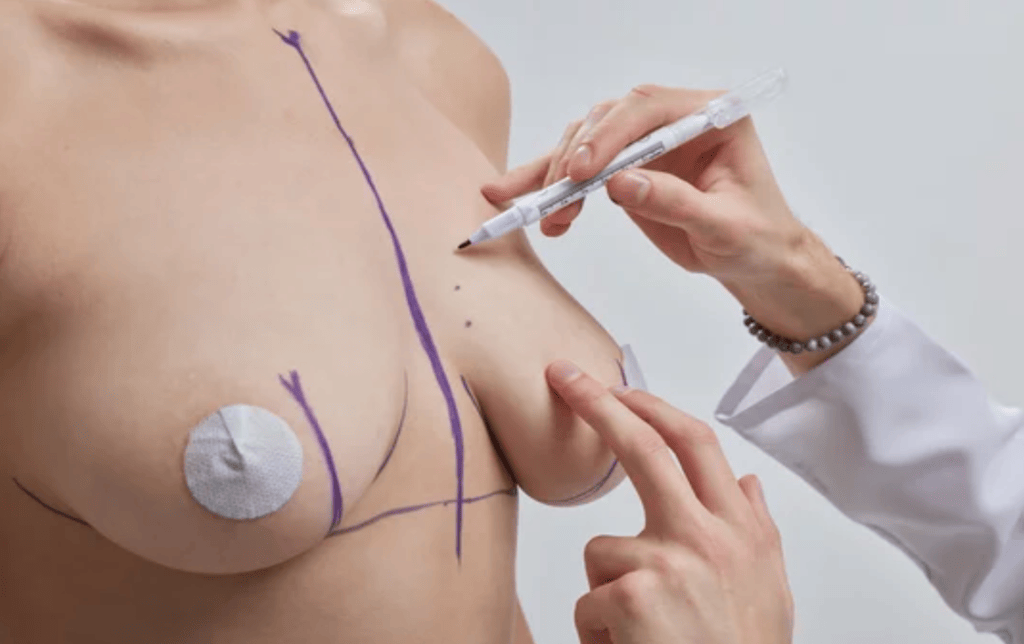 Breast Reduction Surgery Achieving Comfort and Confidence Plastic Surgeon in Nagpur | Cosmetic Surgeon in Nagpur | Dr. Suresh Chawre | Hair Transplant In Nagpur