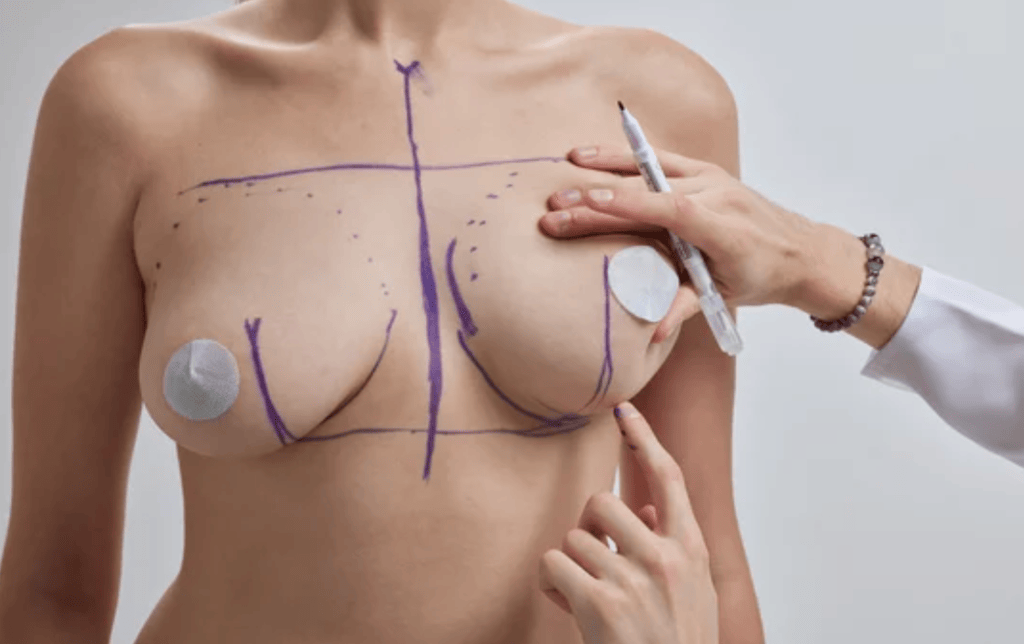 Exploring Cosmetic Breast Surgery Enhancing Beauty and Functionality 1 Plastic Surgeon in Nagpur | Cosmetic Surgeon in Nagpur | Dr. Suresh Chawre | Hair Transplant In Nagpur