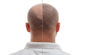 Follicular Unit Extraction FUE Hair Transplant A Comprehensive Guide Plastic Surgeon in Nagpur | Cosmetic Surgeon in Nagpur | Dr. Suresh Chawre | Hair Transplant In Nagpur