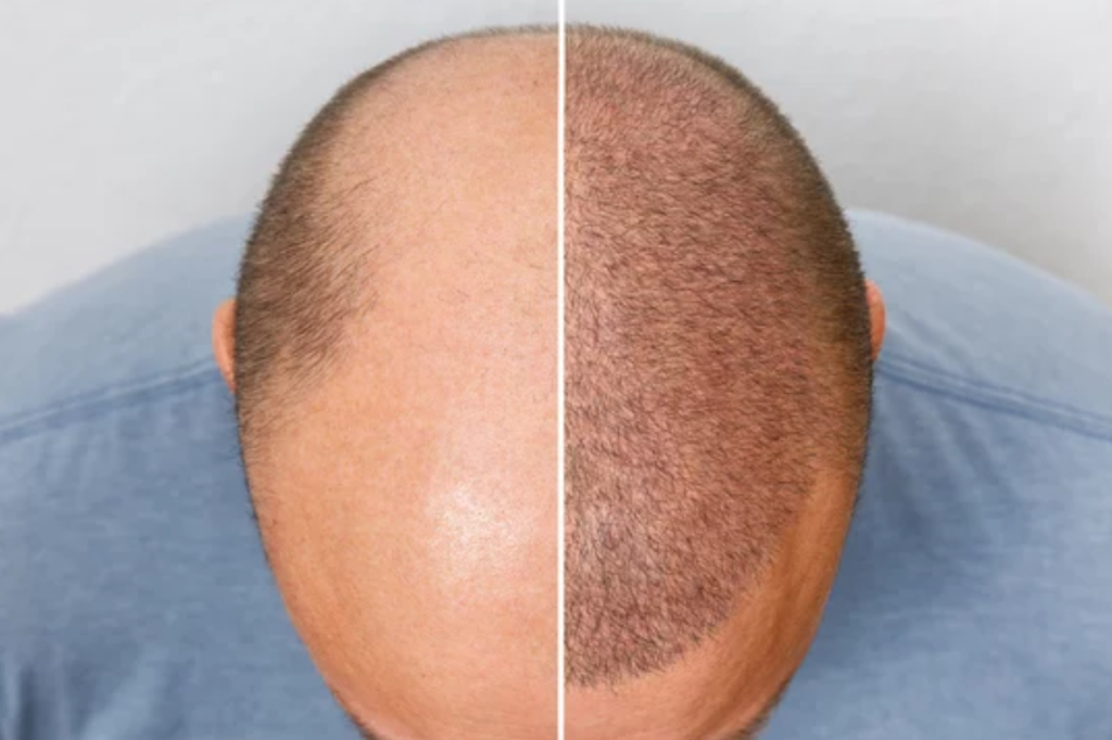 Follicular Unit Transplantation FUT A Comprehensive Guide 1 Plastic Surgeon in Nagpur | Cosmetic Surgeon in Nagpur | Dr. Suresh Chawre | Hair Transplant In Nagpur