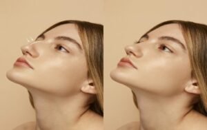 The Art and Science of Rhinoplasty Transforming Nasal Aesthetics and Functionality Plastic Surgeon in Nagpur | Cosmetic Surgeon in Nagpur | Dr. Suresh Chawre | Hair Transplant In Nagpur