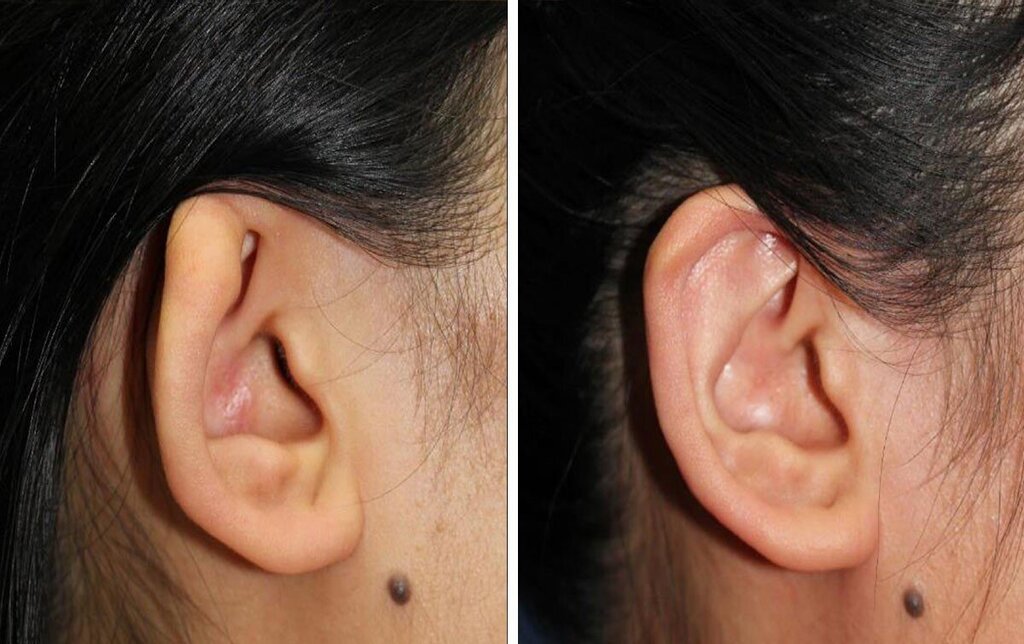 Transforming Lives Through Ear Reconstruction Restoring Form and Function 1 Plastic Surgeon in Nagpur | Cosmetic Surgeon in Nagpur | Dr. Suresh Chawre | Hair Transplant In Nagpur