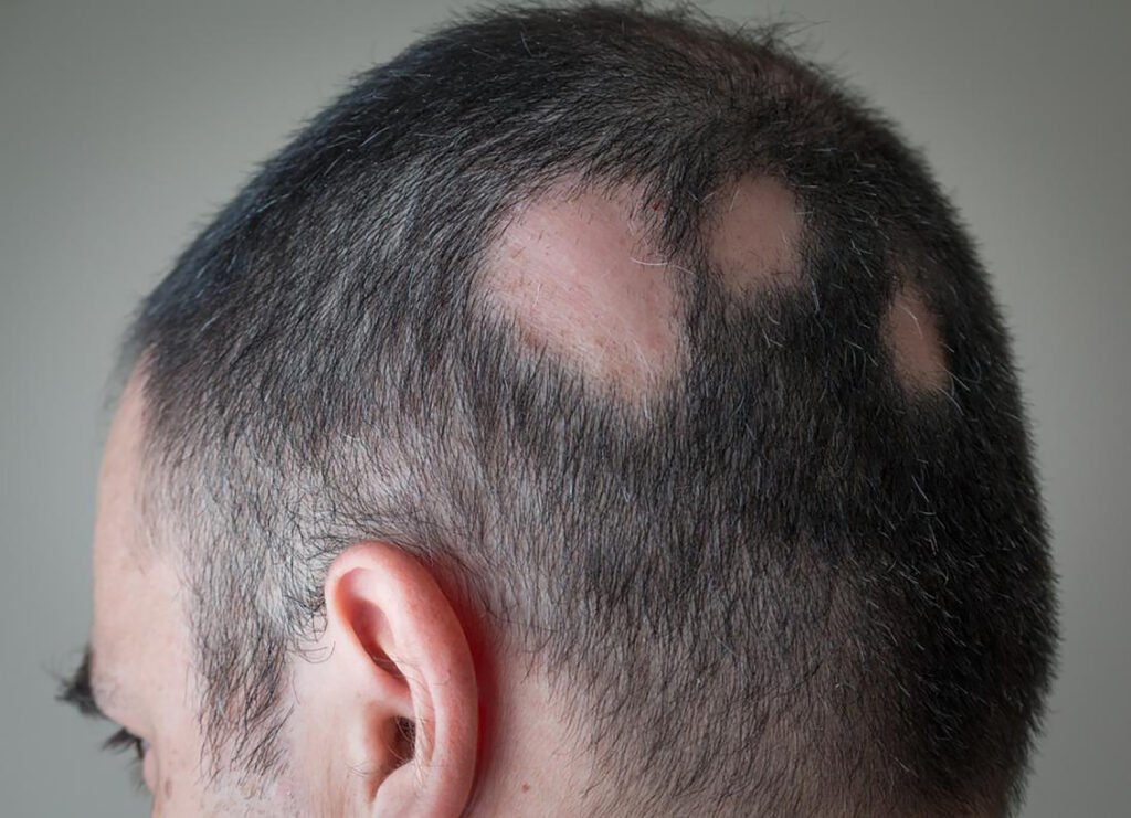 Understanding Alopecia Areata Causes Diagnosis Treatment and Impact 1 Plastic Surgeon in Nagpur | Cosmetic Surgeon in Nagpur | Dr. Suresh Chawre | Hair Transplant In Nagpur