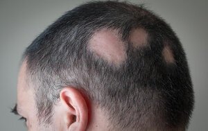 Understanding Alopecia Areata Causes Diagnosis Treatment and Impact Plastic Surgeon in Nagpur | Cosmetic Surgeon in Nagpur | Dr. Suresh Chawre | Hair Transplant In Nagpur