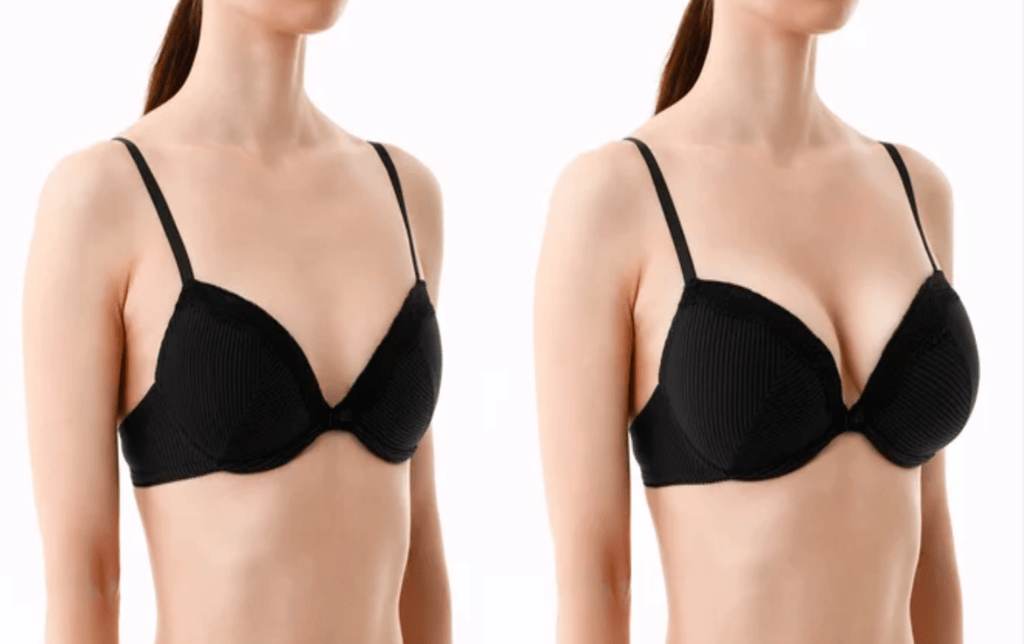 Understanding Breast Augmentation Surgery Enhancing Beauty and Confidence 1 Plastic Surgeon in Nagpur | Cosmetic Surgeon in Nagpur | Dr. Suresh Chawre | Hair Transplant In Nagpur