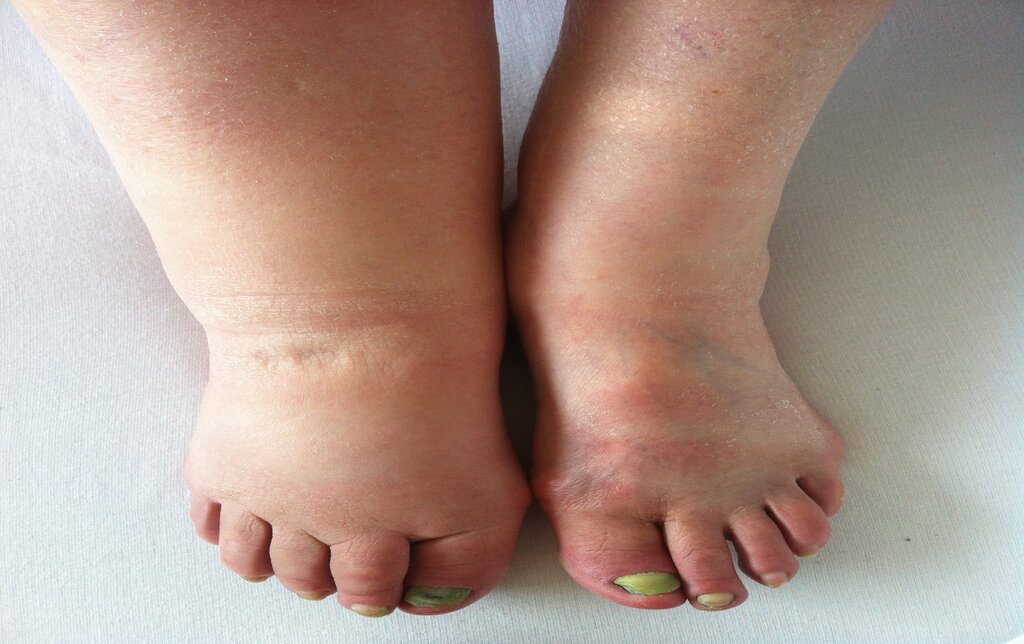 Understanding Lymphedema: Causes, Symptoms, and Treatments