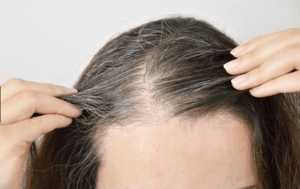 Understanding Telogen Effluvium Causes Symptoms and Management 1 Plastic Surgeon in Nagpur | Cosmetic Surgeon in Nagpur | Dr. Suresh Chawre | Hair Transplant In Nagpur