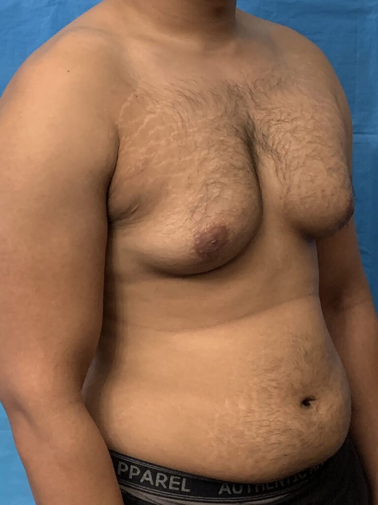 gynecomastia